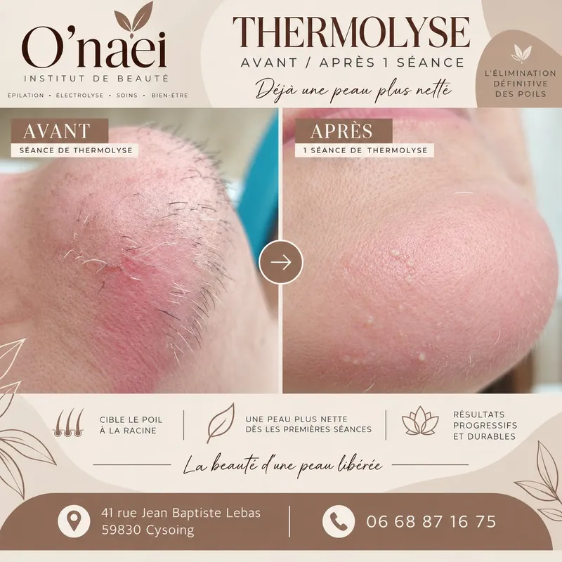 Thermolyse au menton résultat d'une séance de 1H