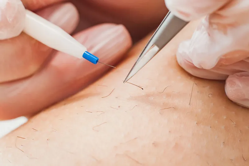 La Thermolyse, l'épilation définitive pour tout le corps